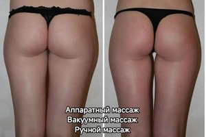 Антицеллюлитный комбинированный массаж — Шанькова Татьяна Владимировна