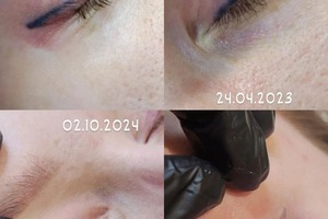 Удаление стрелок — Tattooremoval