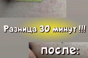 Криолиполиз не подходит пациентам, желающим просто похудеть. Безусловно, вместе с жиром уйдёт небольшое количество... — Артемьева Ксения Андреевна