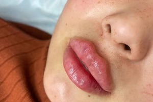 Увеличение губ — Бартули Маргарита Геннадьевна