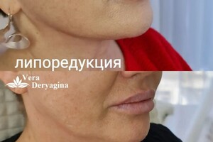 Липосакция второго подбородка. — Дерягина Вера Николаевна