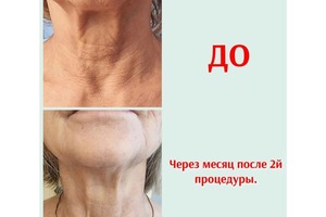 Коррекция овала лица, без уколов, на аппарате Холодной плазмы. Эффект после 2х процедур в возрасте 60+ равен... — Шугайлова Оксана Николаевна