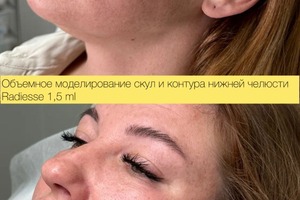 Векторный лифтинг Radiesse — Свинарева Ирина Витальевна