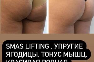 Smas lifting Ягодицы — Леманн Николь Владимировна