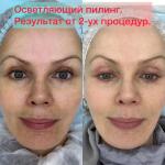 ПИЛИНГ WHITENING Сезонный пилинг для периода с пониженной инсоляцией с осветляющим, кератолитическим и общеомолаживающим эффектом Действие и результаты: Устраняет гиперкератоз благодаря хорошему кератолитическому уходу Обладает осветляющим эффектом (улучшает общий тон лица и уменьшает выраженность имеющихся пигментных пятен, снижает риск новых) Уменьшает глубину морщин и диаметр пор, существенно улучшая рельеф кожи Идеальный клиент: Гиперпигментация различного генеза ПИЛИНГ ACNE Мультисезонный пили — Асадуллина Наталья Петровна