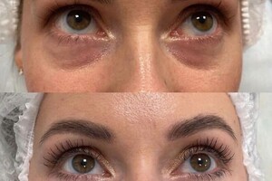 Увеличение губ, препаратом Juvederm Ultra 3 - 1ml — Асланов Расул Асланшаевич