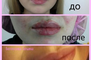 Увеличение губ — Белоусова Татьяна Реджеповна