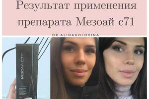 Результат от препарата мезоай — Головина Алина Викторовна