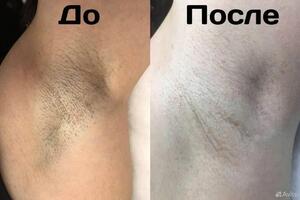 На фото до, подмышки после бритвы. Волос был достаточно жёсткий и плотный. Результат после 10 мес работы, остались... — Кличова Ольга Рахмановна