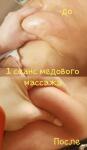 Сделан один сеанс медового массажа живота, в результате кожа стала ровной, гладкой и упругой, уменьшились объёмы. — Суханова Елена Михайловна