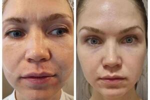 Full Face комплексная омолаживающая процедура, которая позволяет достичь естественного и гармоничного результата. — Якимович Елена Владимировна