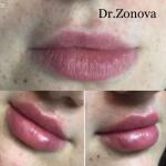 Увеличение губ Juvederm Vollift 1 ml — Зонова Александра Андреевна