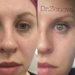 Коррекция носослезной борозды Juvederm Volbella 1 ml — Зонова Александра Андреевна