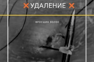 Удаление вросших, открытых комедонов (сальные пробки) через которые не может пробиться волос в результате врастает и... — Маслова Наталья Владимировна