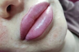 Аутлева Ирина Николаевна — Лазерная эпиляция гибрид.диодный,трехволновый. — Портфолио №11