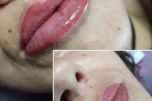 Аутлева Ирина Николаевна — Увеличение губ первичное — Портфолио №20