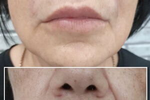 Аутлева Ирина Николаевна — Коррекция носогубных складок — Портфолио №28