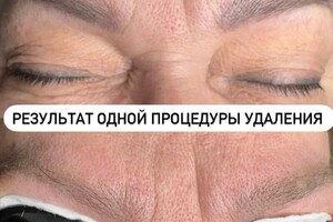 БАРЫНИНА Анна Николаевна — Безопасное удаление татуажа и татуировок на неодимовом Q-switched лазерe:; -бесплатная консультация; -гарантия... — Портфолио №29