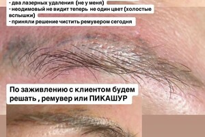 БАРЫНИНА Анна Николаевна — Удаление татуажа ремувером - это метод выведения пигмента из кожи с помощью специального химического состава, который... — Портфолио №31