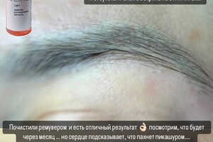 БАРЫНИНА Анна Николаевна — Удаление татуажа ремувером - это метод выведения пигмента из кожи с помощью специального химического состава, который... — Портфолио №34