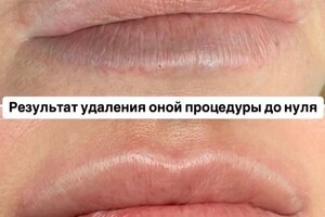 БАРЫНИНА Анна Николаевна — Безопасное удаление татуажа и татуировок на неодимовом Q-switched лазерe:; -бесплатная консультация; -гарантия... — Портфолио №53