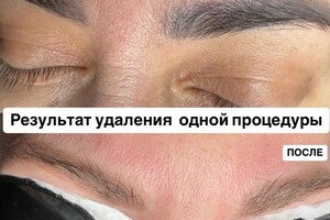 БАРЫНИНА Анна Николаевна — Безопасное удаление татуажа и татуировок на неодимовом Q-switched лазерe:; -бесплатная консультация; -гарантия... — Портфолио №54