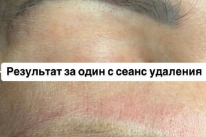 БАРЫНИНА Анна Николаевна — Безопасное удаление татуажа и татуировок на неодимовом Q-switched лазерe:; -бесплатная консультация; -гарантия... — Портфолио №55