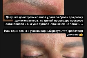 БАРЫНИНА Анна Николаевна — Безопасное удаление татуажа и татуировок на неодимовом Q-switched лазерe:; -бесплатная консультация; -гарантия... — Портфолио №71