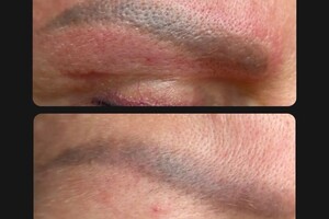 БАРЫНИНА Анна Николаевна — Безопасное удаление татуажа и татуировок на неодимовом Q-switched лазерe:; -бесплатная консультация; -гарантия... — Портфолио №73