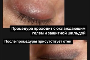 БАРЫНИНА Анна Николаевна — Безопасное удаление татуажа и татуировок на неодимовом Q-switched лазерe:; -бесплатная консультация; -гарантия... — Портфолио №74