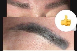 БАРЫНИНА Анна Николаевна — Безопасное удаление татуажа и татуировок на неодимовом Q-switched лазерe:; -бесплатная консультация; -гарантия... — Портфолио №75