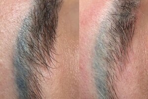 БАРЫНИНА Анна Николаевна — Безопасное удаление татуажа и татуировок на неодимовом Q-switched лазерe:; -бесплатная консультация; -гарантия... — Портфолио №76