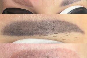 БАРЫНИНА Анна Николаевна — Безопасное удаление татуажа и татуировок на неодимовом Q-switched лазерe:; -бесплатная консультация; -гарантия... — Портфолио №77