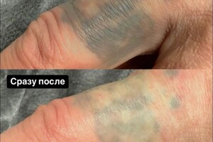 БАРЫНИНА Анна Николаевна — Безопасное удаление татуажа и татуировок на неодимовом Q-switched лазерe:; -бесплатная консультация; -гарантия... — Портфолио №78