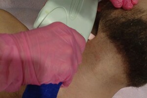 Белова Светлана Георгиевна — Лазерная эпиляция мужская — Портфолио №1