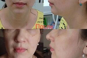 Белова Светлана Георгиевна — Массаж лица Мадеротерапия с пилингом — Портфолио №3