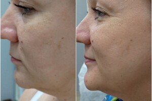 Белова Светлана Георгиевна — Массаж лица Мадеротерапия — Портфолио №4