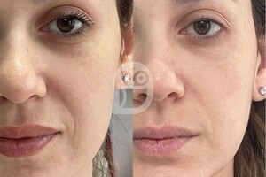 Белова Светлана Георгиевна — Чистка с применением лимфодренажного состава — Портфолио №5