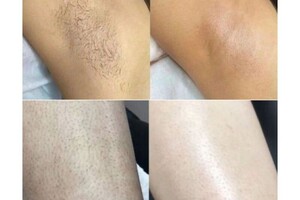 Белова Светлана Георгиевна — Результат после нескольких сеансов процедуры лазерной эпиляции — Портфолио №6