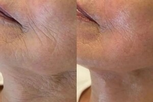 Белова Светлана Георгиевна — Биоревитализация с пептидами и экзосомами это современная косметологическая процедура, которая сочетает в себе... — Портфолио №7