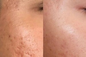 Белова Светлана Георгиевна — Микроигольчатая фракционная мезотерапия: Аппаратная процедура, которая стимулирует обновление кожи на клеточном уровне. — Портфолио №8