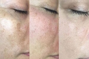 Белова Светлана Георгиевна — Мезотерапия: Инъекционное введение специальных коктейлей, в том числе с витамином C, для осветления и улучшения... — Портфолио №9