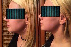 Бутенко Марина Николаевна — Подтянулся овал лица, второй подбородок заметно уменьшился — Портфолио №1