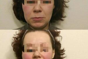 Бутенко Марина Николаевна — На фото ДО у клиентки очень напряжены губы , скулы, подбородок.; На фото ПОСЛЕ расслабились и расцвели губы,... — Портфолио №3