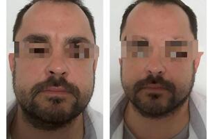 Бутенко Марина Николаевна — На фото ДО морщинка между бровями.; На фото ПОСЛЕ морщинка ушла. — Портфолио №4