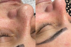 Демченко Екатерина Сергеевна — Чистка лица — Портфолио №1