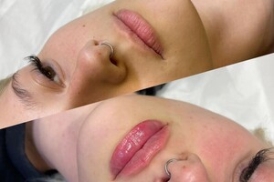 Демченко Екатерина Сергеевна — Контурная пластика губ — Портфолио №2