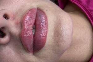 Демченко Екатерина Сергеевна — Контурная пластика губ — Портфолио №3