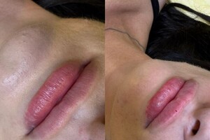 Демченко Екатерина Сергеевна — Контурная пластика губ — Портфолио №5