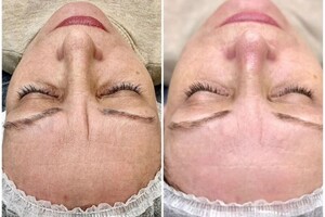 Дидимова Виктория Петровна — Чистка, пилинг, маска — Портфолио №3